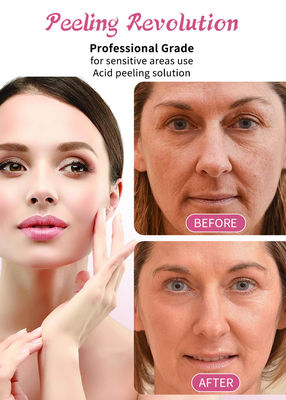 30 ml de suero para pelar la piel / conjunto de líquido de calidad profesional para solución de exfoliación de la piel facial