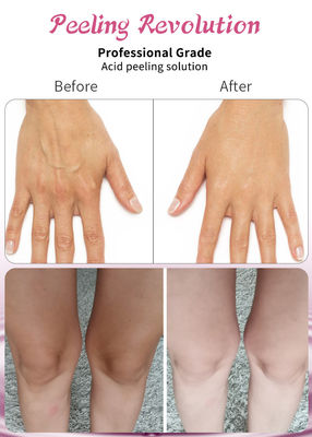 Solución de exfoliación con ácido de calidad profesional