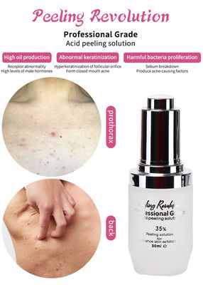 Soro exfoliante Solución para pelar la piel Eliminator de acné Cuidado de la piel Pelar la piel 30 ml