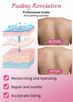 Soro exfoliante Solución para pelar la piel Eliminator de acné Cuidado de la piel Pelar la piel 30 ml