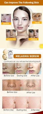 El suero meso Melasma de la peca del retiro de Microneedling del suero de Skincare pela blanquear