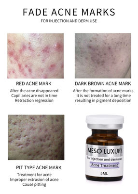 MESO LUXURY Solución de Mesoterapia Inyectable Exosomas Suero Manchas Rojas Tratamiento del Acné Cutáneo