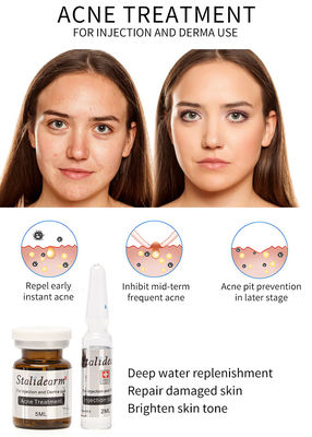 Suero Mesotherapy de la inyección del tratamiento del acné de Stalidearm que no alimenta ningún efecto secundario